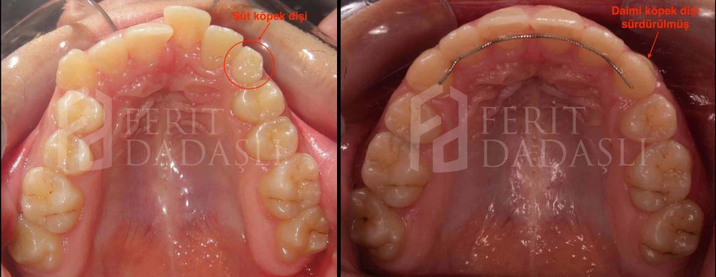 gömülü diş ve tedavisi