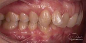 Sınıf iki maloklüzyon. Alt çene üst çeneye göre geride konumlanmıştır.