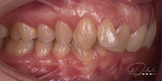 Sınıf iki maloklüzyon. Alt çene üst çeneye göre geride konumlanmıştır.