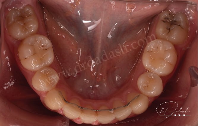 A fixed lingual retainer that is bonded to the tongue-facing surfaces of the lower teeth after orthodontic treatment is completed.