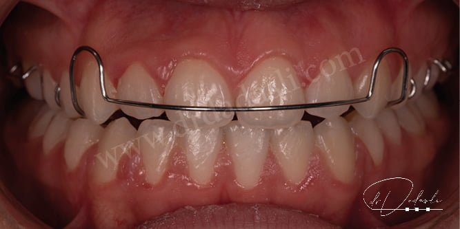 Hawley appliance, one of the removable retainers. The wire of the appliance passing through the outer surface of the front teeth is visible.