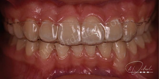 A clear retainer on the upper jaw to prevent teeth from deteriorating after orthodontic treatment is completed.